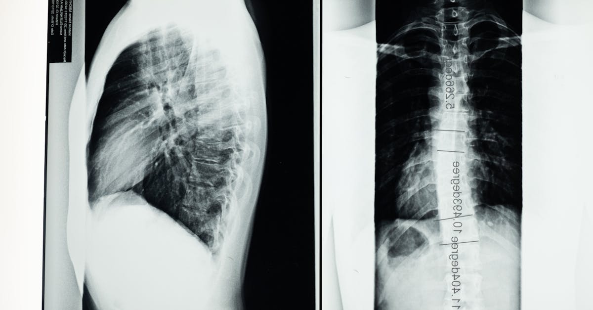 learn about scoliosis, a common spinal condition characterized by an abnormal curve of the spine. discover symptoms, causes, treatment options, and management strategies to improve quality of life for those living with scoliosis.