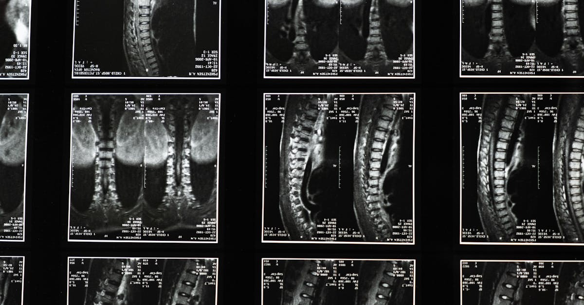 discover essential insights about spinal stenosis, its causes, symptoms, and treatment options. learn how to manage this condition and improve your quality of life with expert advice and resources.