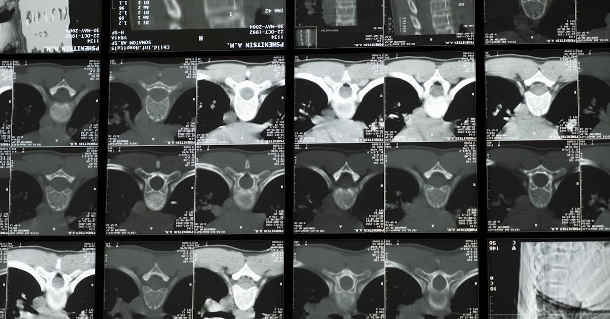 discover essential insights about scoliosis, its symptoms, causes, and treatment options. learn how early diagnosis and innovative therapies can help manage this spinal condition effectively.