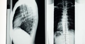 discover essential insights about scoliosis, a common spinal condition characterized by an abnormal curvature of the spine. learn about its causes, symptoms, diagnosis, and effective treatment options to manage and improve quality of life.